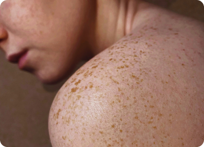 A shoulder with skin pigmentation